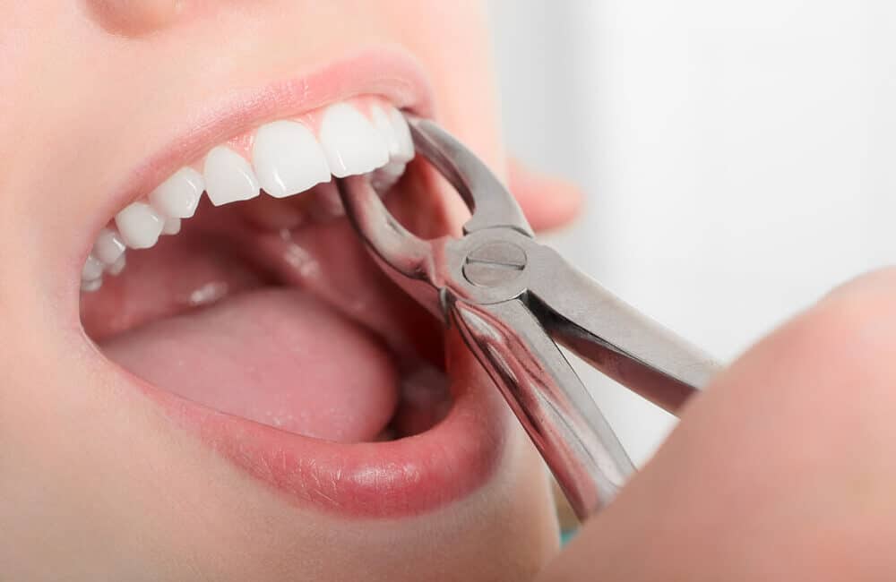 usuwanie zęba