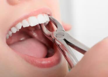 Czego warto unikać przed usuwaniem zęba?