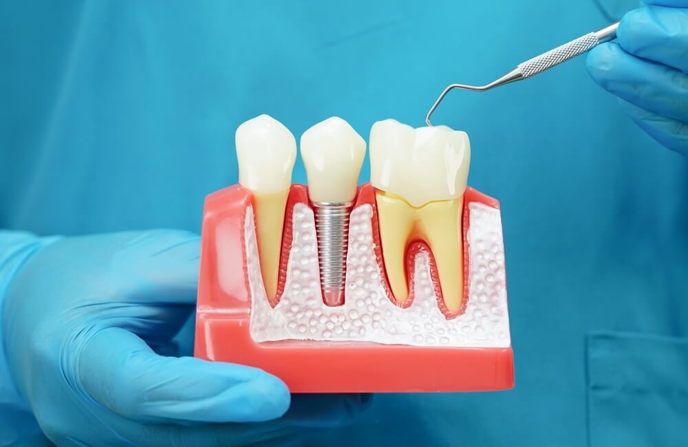 proces-gojenia-po-wszczepieniu-implantu-zebowego