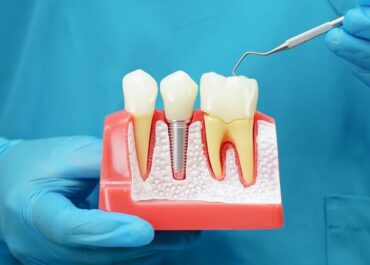 Jak przebiega proces gojenia po wszczepieniu implantu?